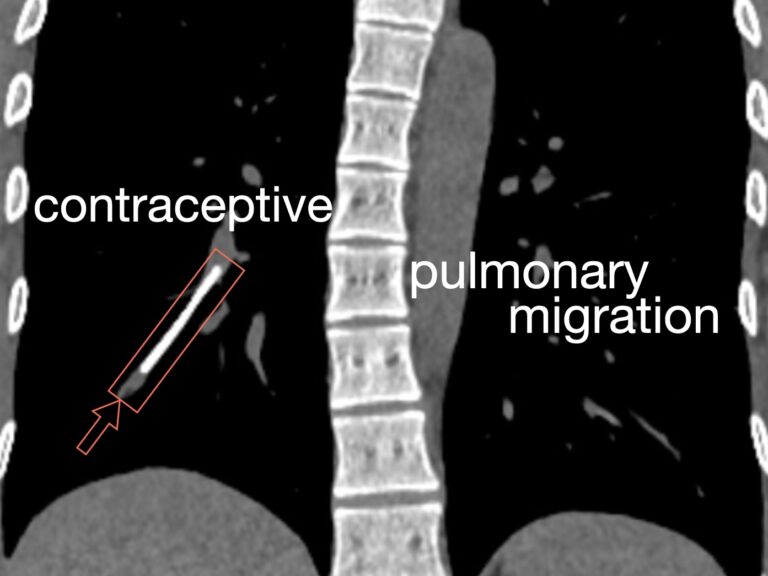 contraceptive pulmonary migration 680